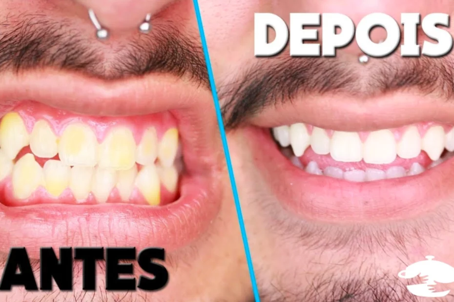 clarear os dentes