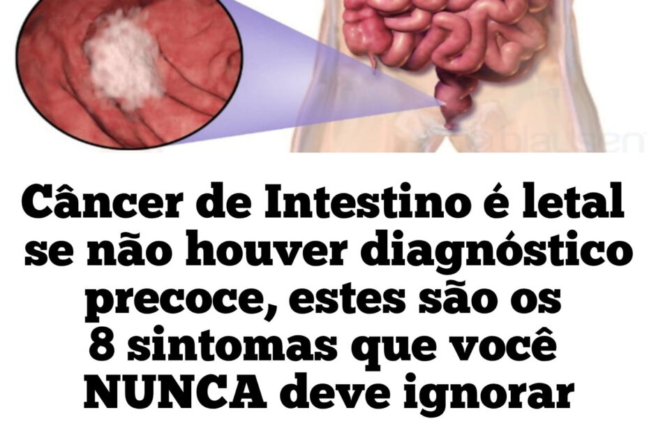 cancêr de intestino