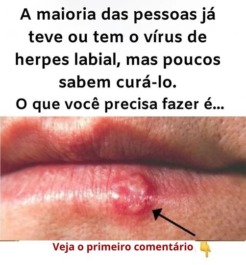 Como curar herpes labial