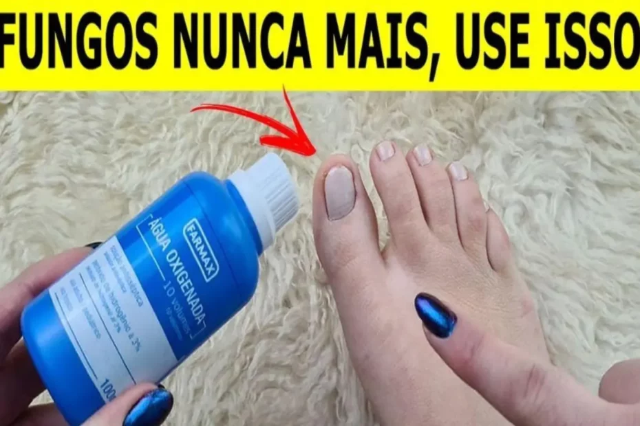 fungos e a micose nas unhas