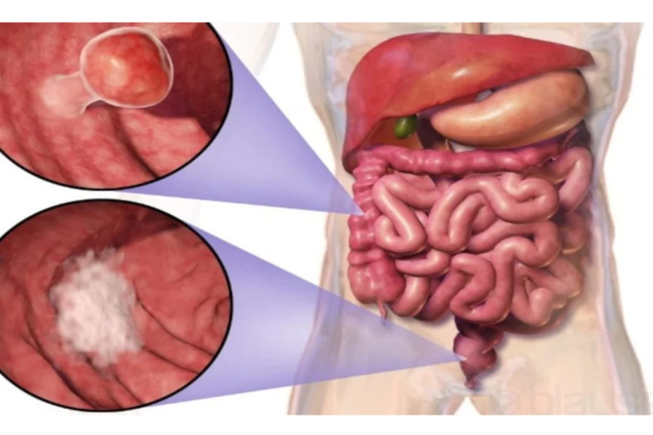 câncer de intestino